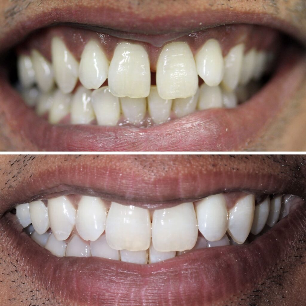 Teeth Straightening with aligners