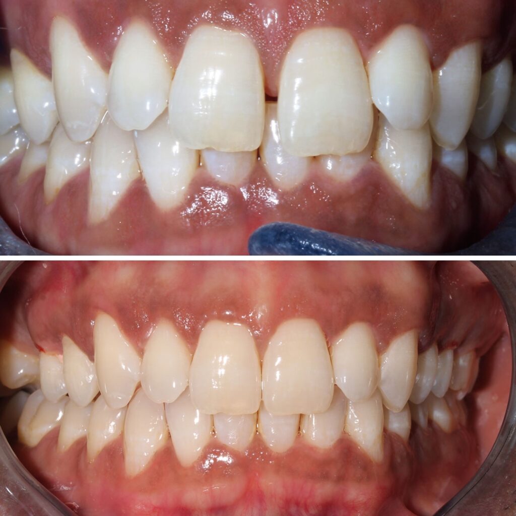 Teeth Straightening with aligners