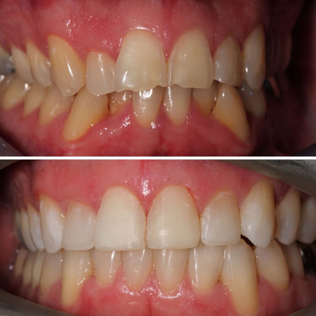 Teeth Straightening with aligners before after