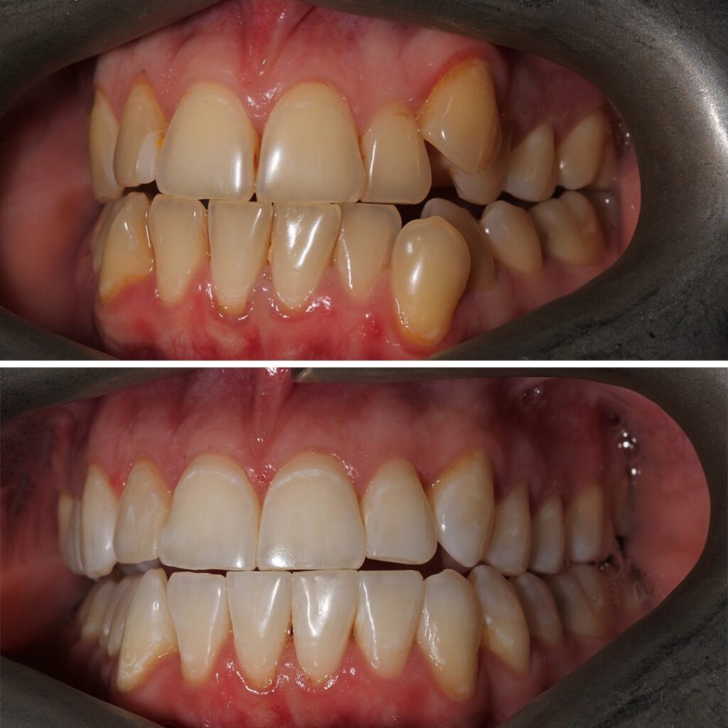 Teeth Straightening with aligners before after