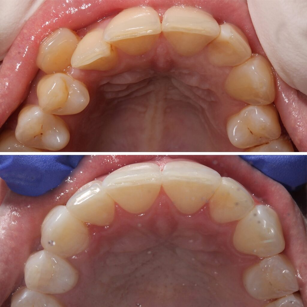 Teeth Straightening with aligners before after