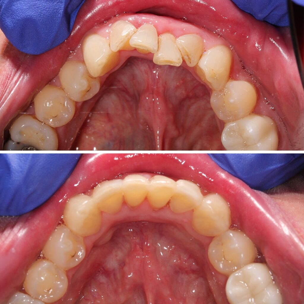 Teeth Straightening with aligners before after