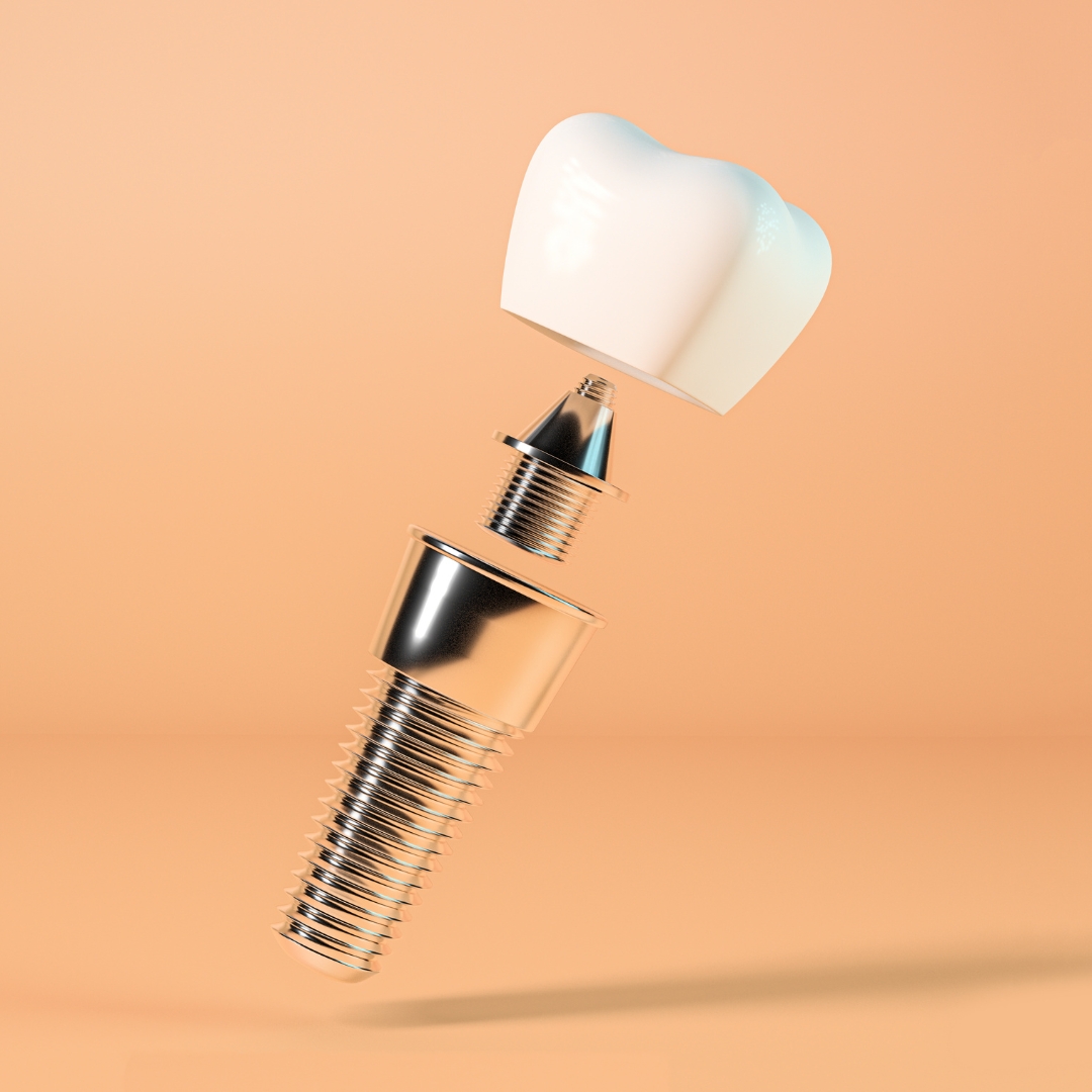 Patient with a confident smile after dental implant treatment