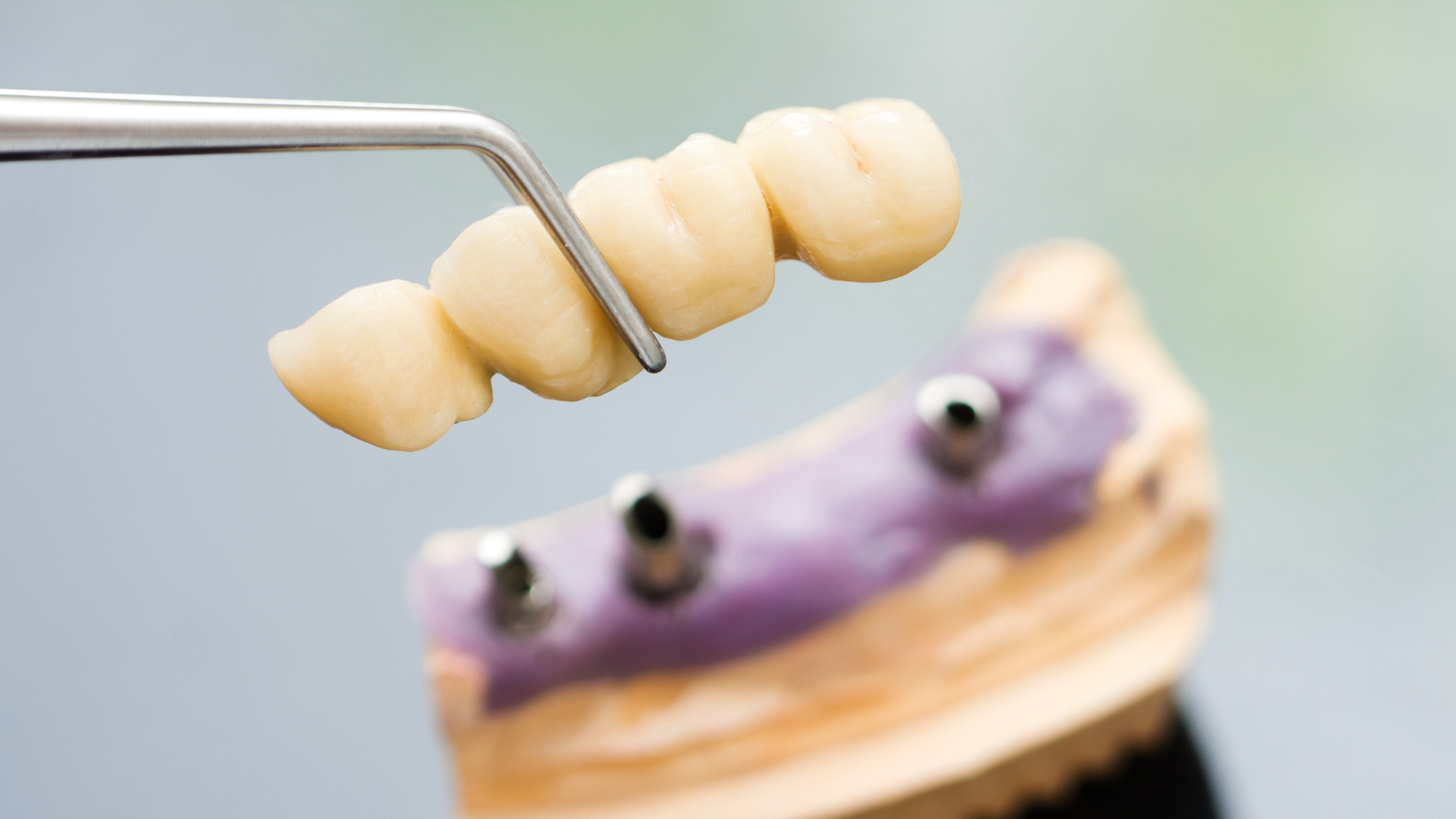 Implant retained denture