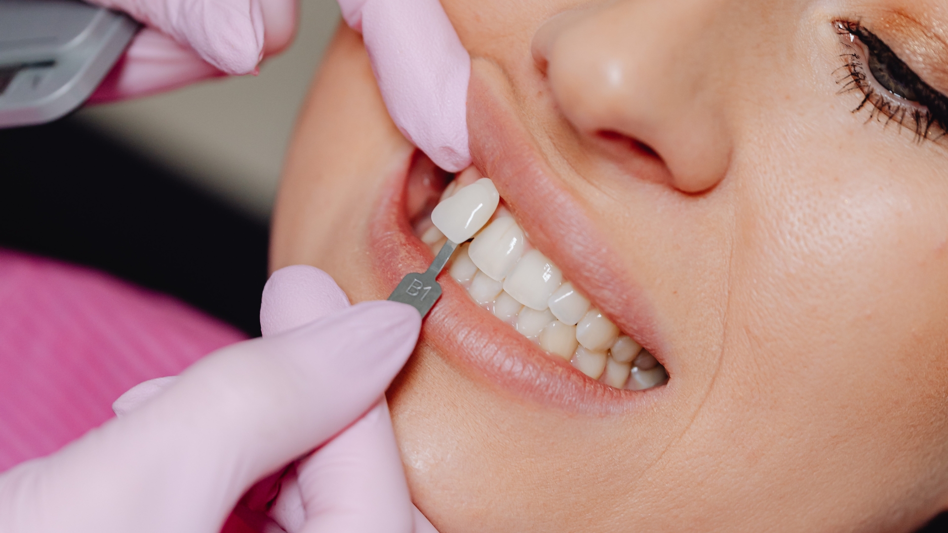 Single dental implant crown