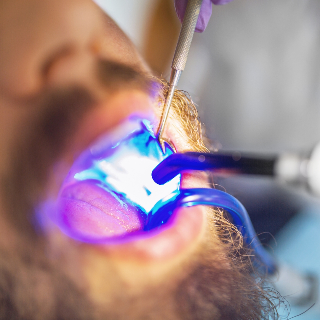 Tooth restoration treatment at Open Dental Care Islington