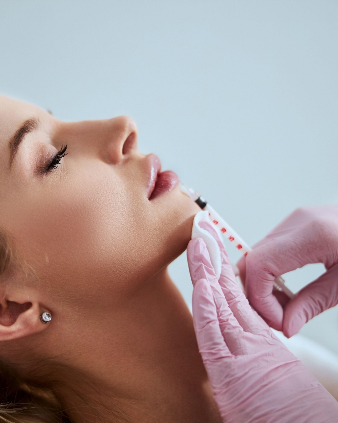 Lip filler treatment at Open Beauty Islington