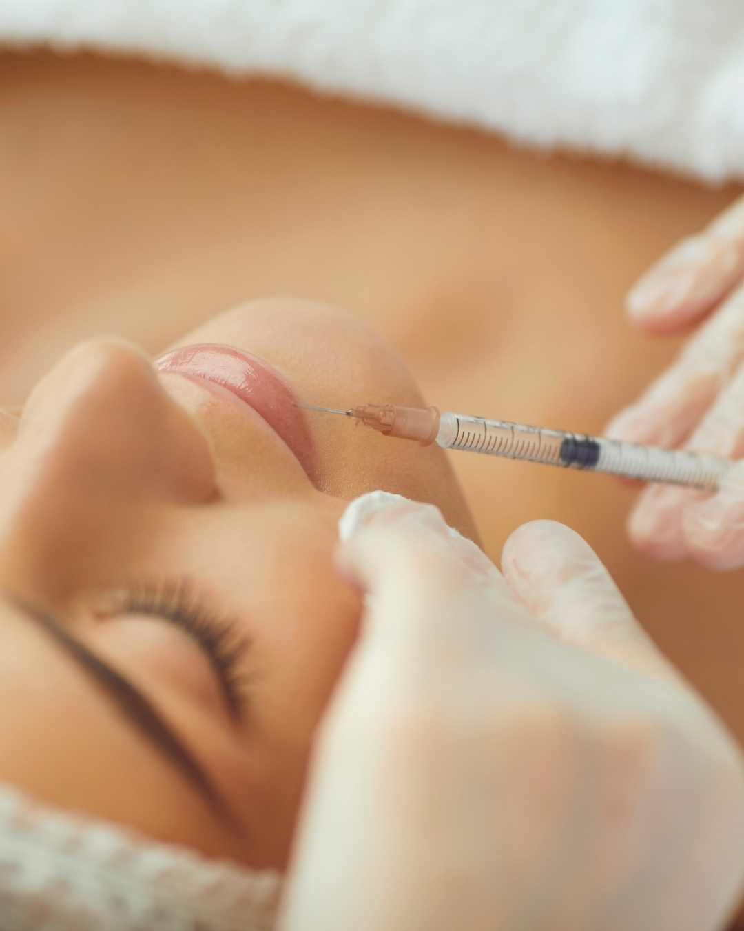 Dermal filler treatment at Open Beauty, Islington