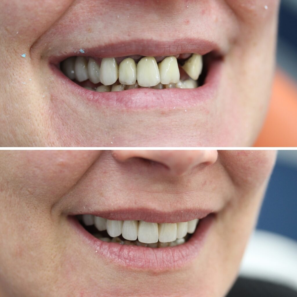Dr Margarita's dental implant cases before and afters