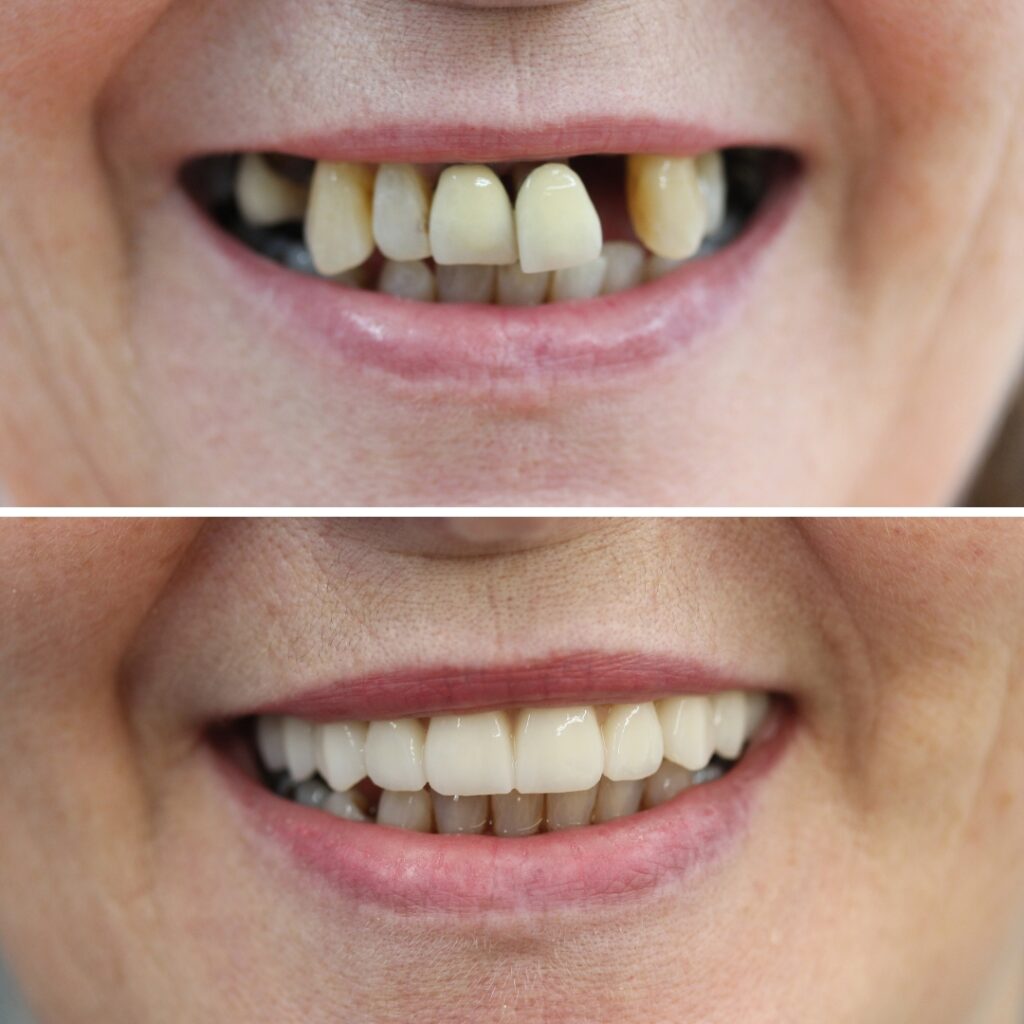 Dr Margarita's dental implant cases before and afters