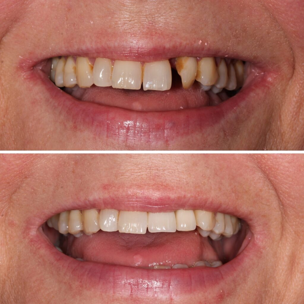 Dr Margarita's dental implant cases before and afters