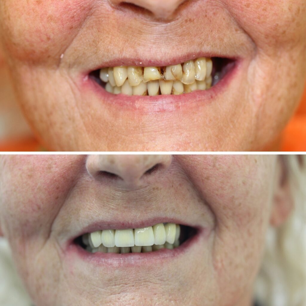 Dr Margarita's dental implant cases before and afters